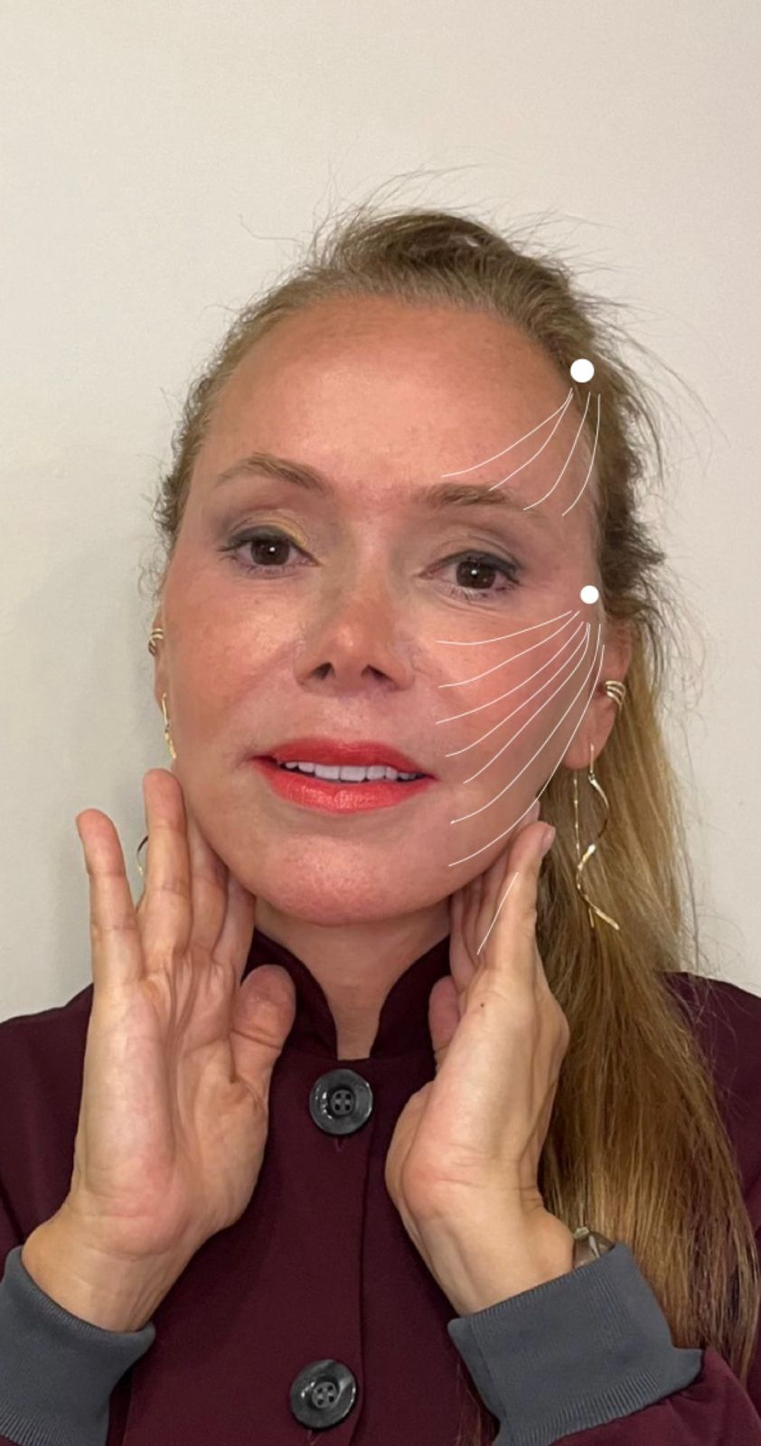 Lifting Facial Com Fios - Dra. Paula Gomes - Medicina Estética